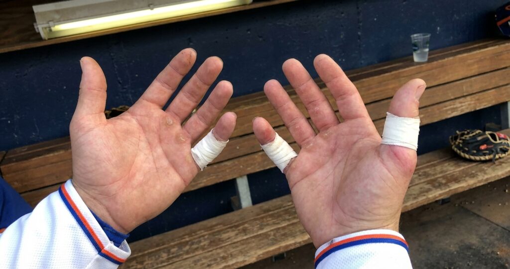 Mets Catcher Plays Through 4 Hand Injuries In 24 Months—Then His Bat Explodes Mid-Swing