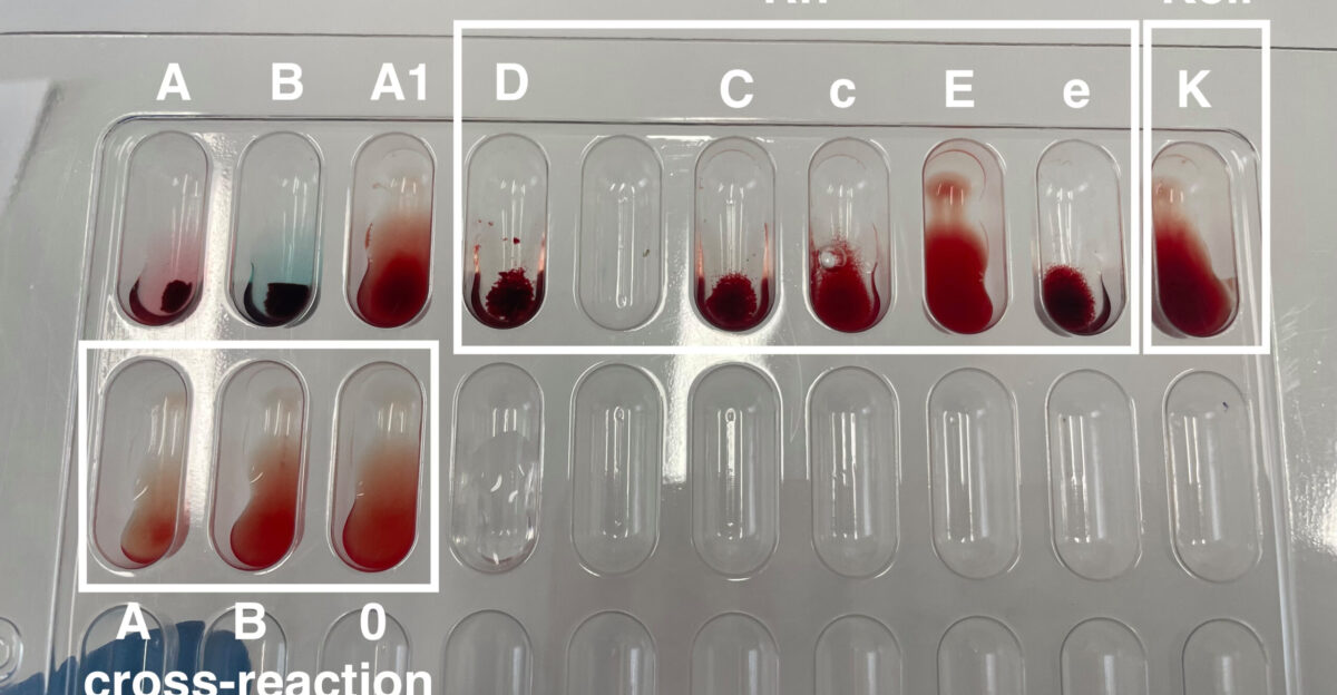 Standard typing for blood groups according to AB0 Kell and Rh systems Wells A and B have agglutination wells of the Rh system also have agglutination so the patient has AB IV Rh blood type Wells D C c and e show agglutination positive E and K - no agglutination negative