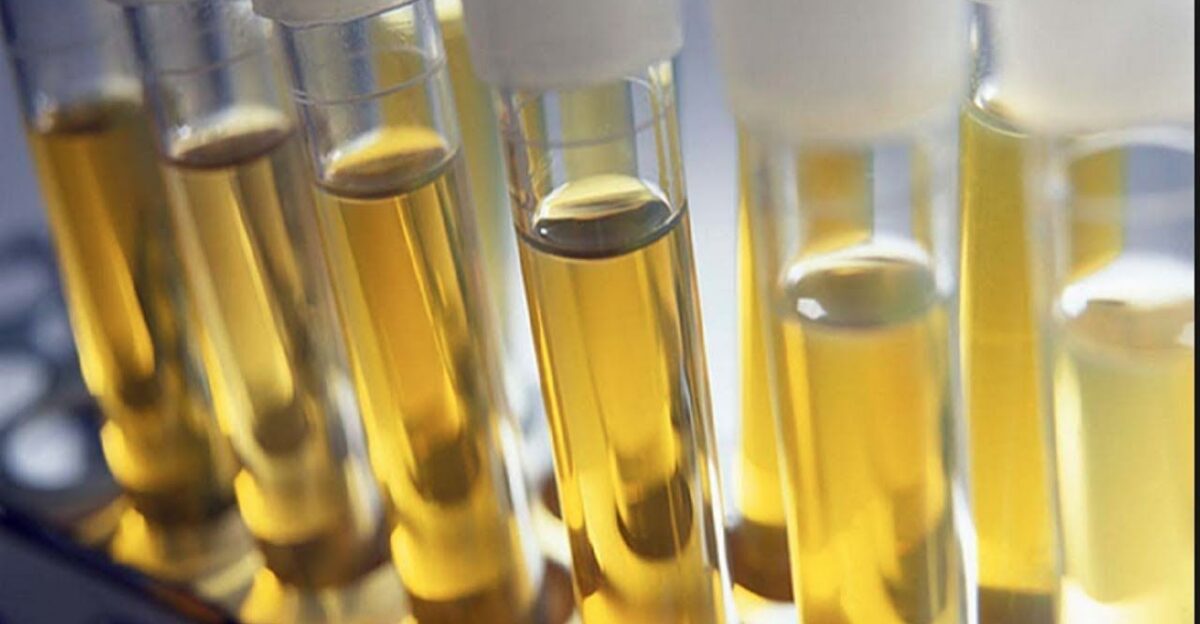 Urine test to diagnosis various diseases DOCTOR S TIPS by ahsan habib