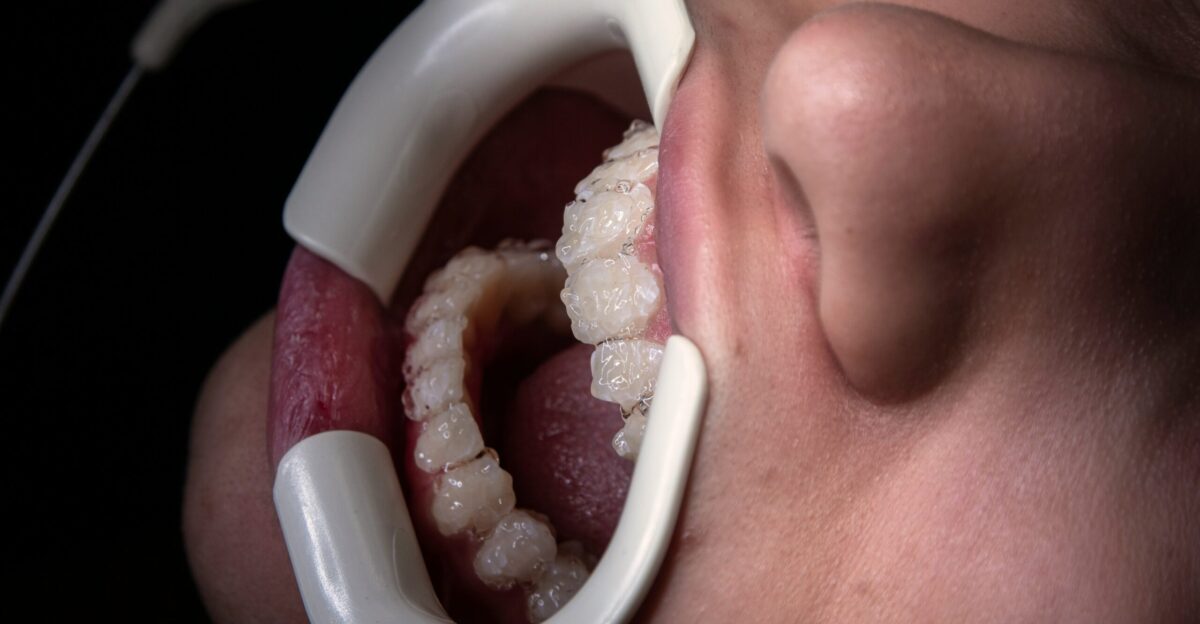 a close up of a person s mouth with a dental device attached to it