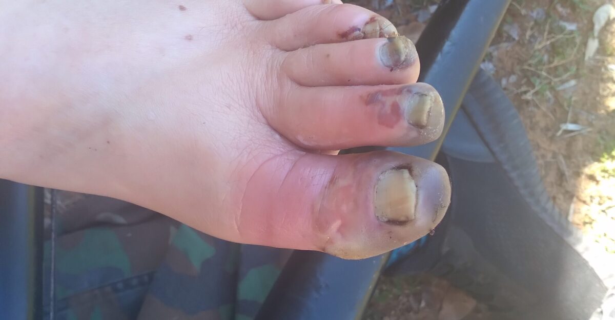 Toes frost bite 2024 medical toe