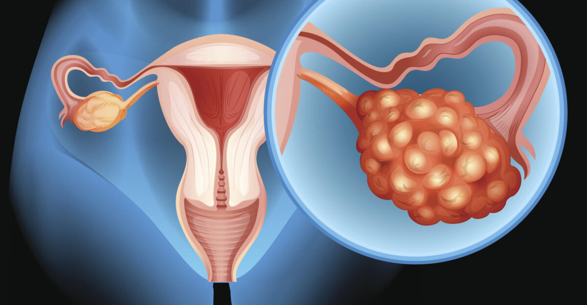 Trametinib to Treat Low-Grade Serous Ovarian Cancer - NCI