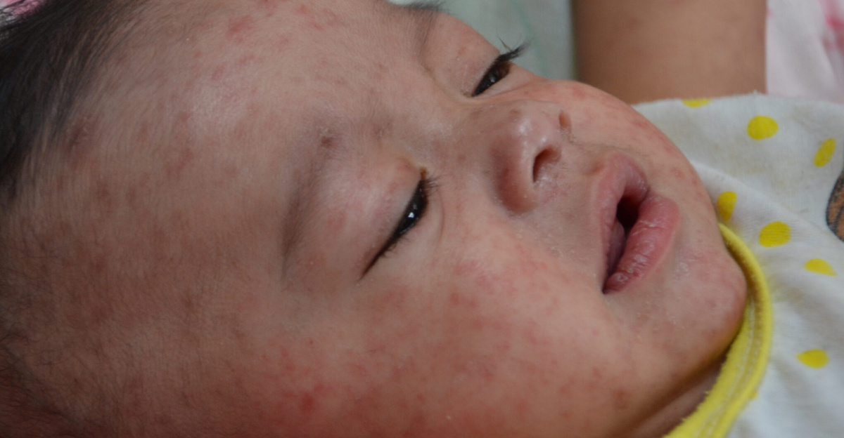 A baby with <a href="//commons.wikimedia.org/wiki/Measles" title="Measles">measles</a> in 2014.