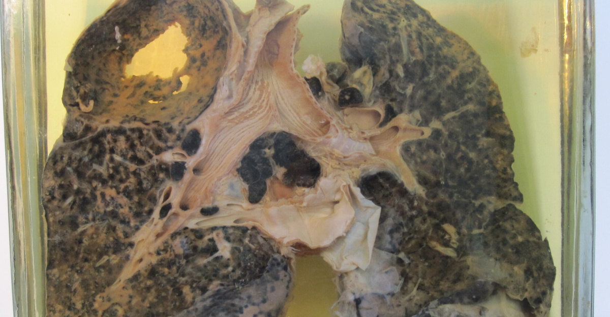 Miner's lung with <a href="https://en.wikipedia.org/wiki/Silicosis" class="extiw" title="en:Silicosis">silicosis</a> and <a href="https://en.wikipedia.org/wiki/Tuberculosis" class="extiw" title="en:Tuberculosis">tuberculosis</a>