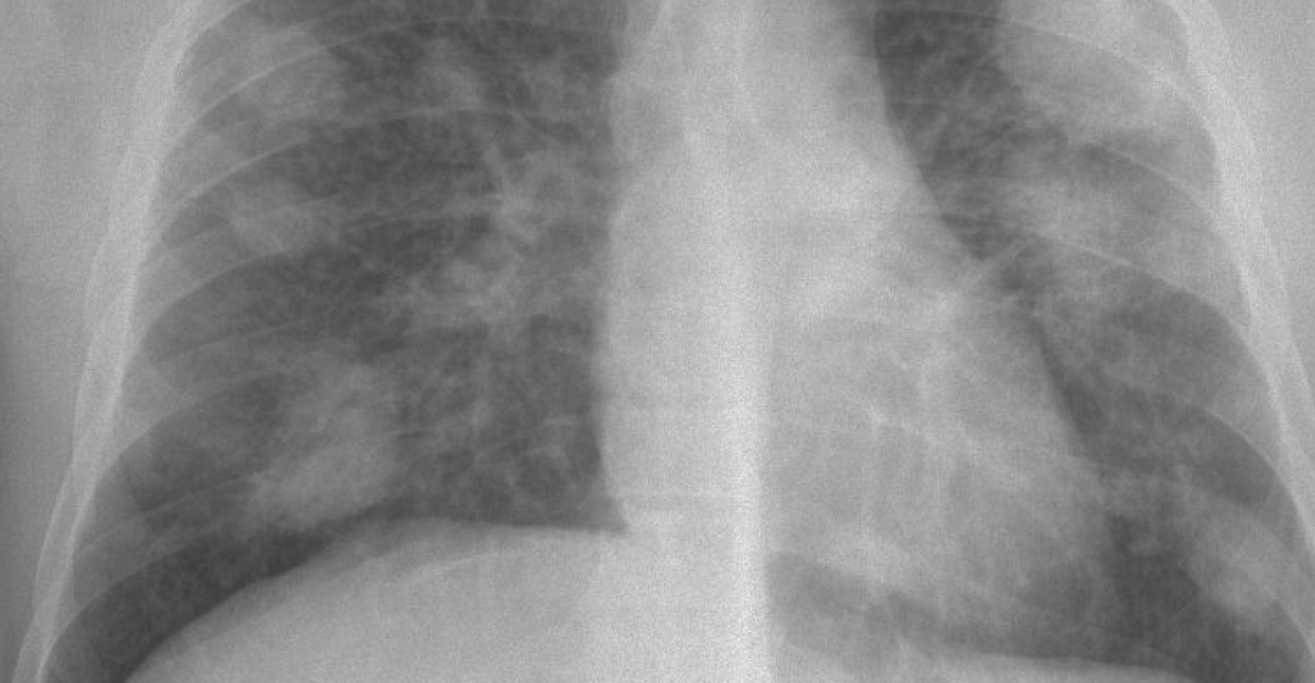 Silicosis complicada