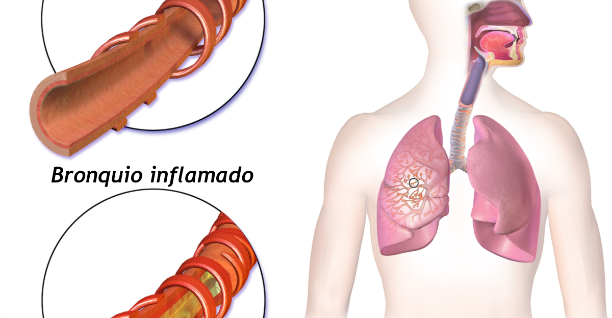 Bronquitis Vea una animaci n completa de este tema m dico